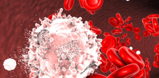 Quels sont les facteurs de risque de la leucémie ?