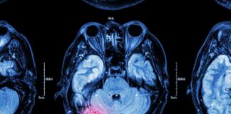 Cancer du cerveau: Il lui restait neuf mois à vivre mais un événement lui change la vie