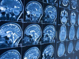 Alzheimer: Une IRM pourrait détecter la maladie 9 ans avant les premiers symptômes