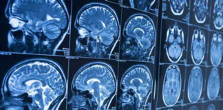 Alzheimer: Une IRM pourrait détecter la maladie 9 ans avant les premiers symptômes