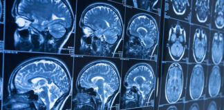 Un implant cérébral intelligent: Une révolution pour les malades de Parkinson