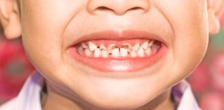 MIH: La maladie qui fragilise l’émail des dents des enfants et favorise les caries