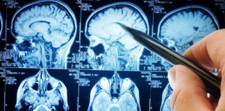 Cancer du cerveau : comprendre les facteurs de risque identifiés