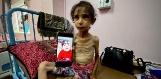 Blocus sioniste sur Ghaza: Un quart des enfants de moins de 5 ans souffrent de malnutrition