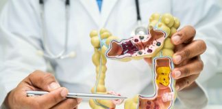 Cancer colorectal: Une étude britannique confirme le rôle aggravant de l’alcool et les vertus protectrices du calcium