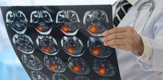 Une étude révèle deux alertes précoces de la sclérose en plaques, 15 ans avant le diagnostic