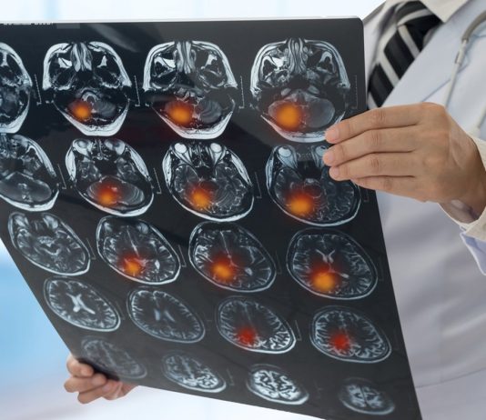 Une étude révèle deux alertes précoces de la sclérose en plaques, 15 ans avant le diagnostic